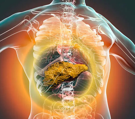 Fatty liver with severe inflammation – diagnosis and treatment