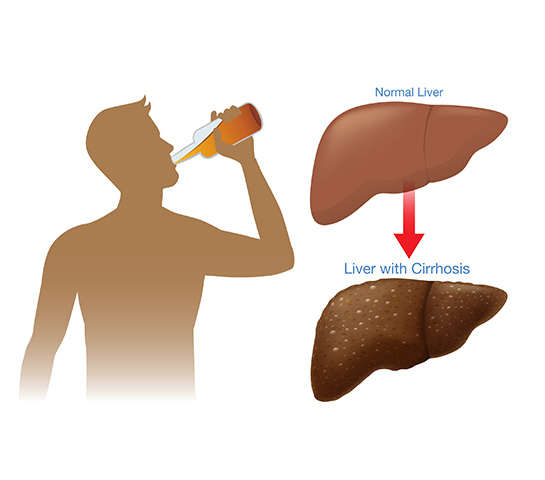 Alcoholic Liver Disease Treatment