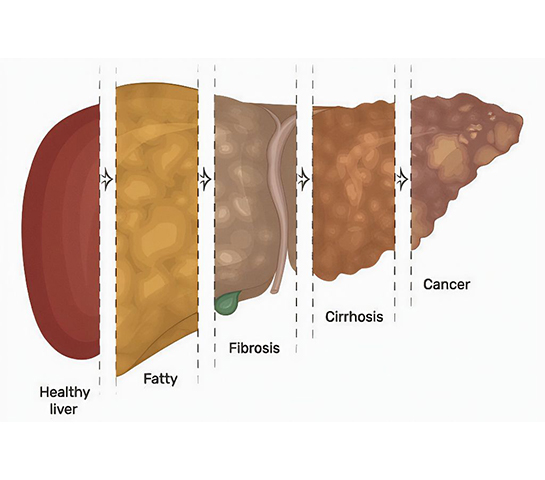 Alcoholic Liver Disease caused by excessive beer and alcohol