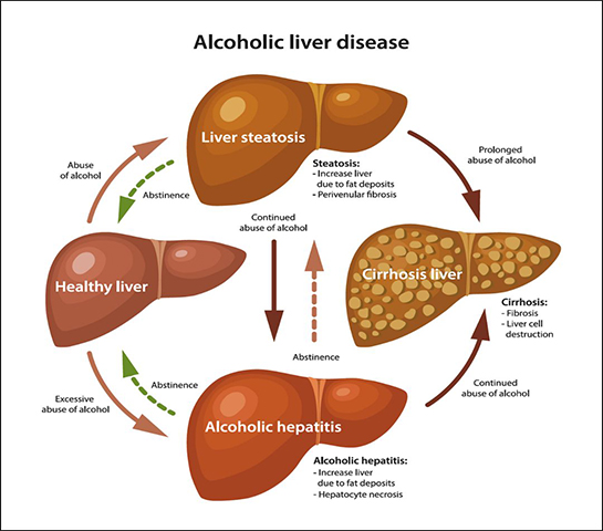 Alcoholic Liver Disease Treatment