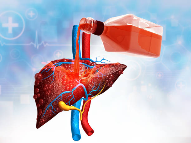 Alcoholic Liver Disease caused by excessive beer and alcohol